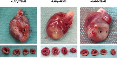 Ventricular stabilization with a customized decellularized cardiac ECM-based scaffold after myocardial infarction alters gene expression in a rodent LAD-ligation model